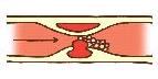中梗塞アテローム血栓性脳梗塞　Inside infarct atheroma thrombus cerebral infarction